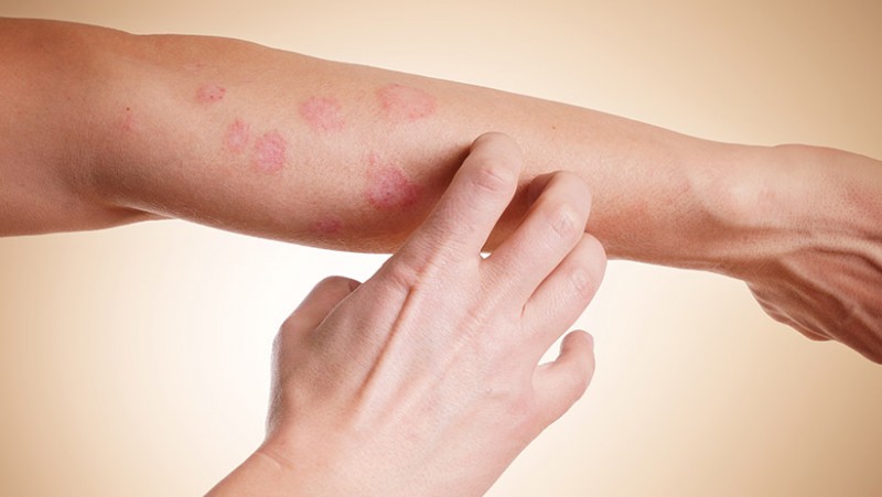 Área avermelhada que coça ou descasca, sintoma do cancer de pele.